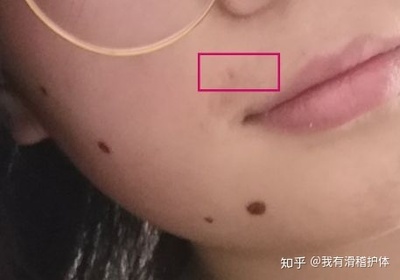 点痣后又长出来了怎么办