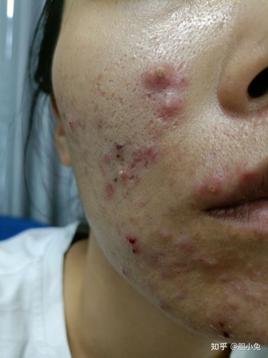 中草药痘痘怎么样