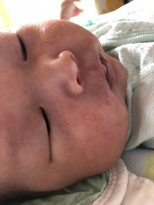 新生儿为什么会长痤疮