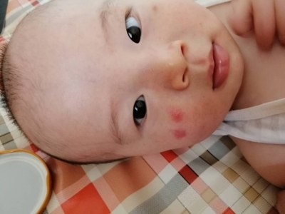 4个月宝宝脸上长红疙瘩
