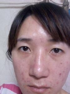 痘痘变黑要挤吗
