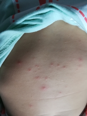 腹部长痘痘