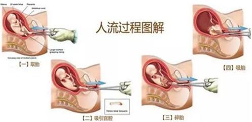 刚怀孕能做人流吗