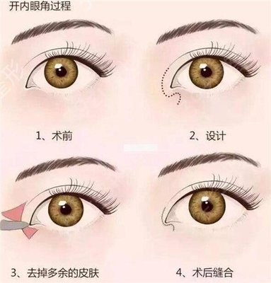 做完双眼皮的注意事项有哪些