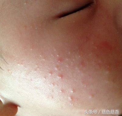 初生婴儿湿疹怎么治疗