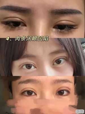 双眼皮割深了