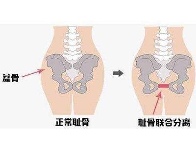 孕妇 耻骨联合分离