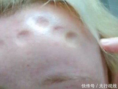 过敏脸肿了是怎么回事