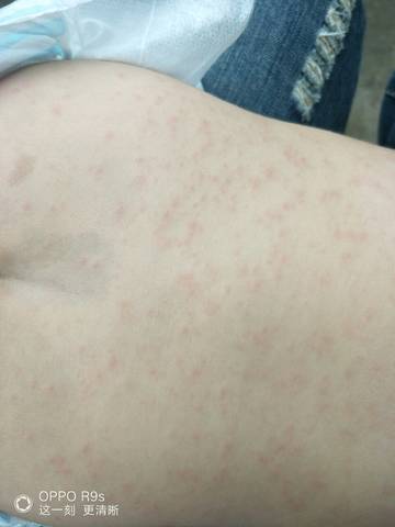 8个月宝宝身上长了很多红点