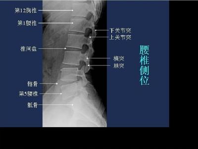 腰5椎弓峡部裂怎么治疗
