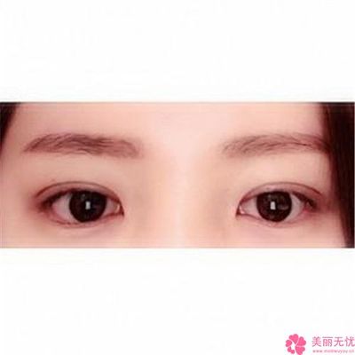双眼皮忌口多久