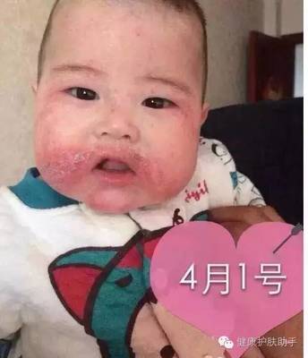 小孩的湿疹怎么治疗最好方法