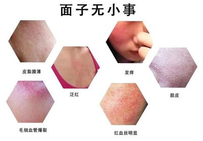 酒精 痘痘