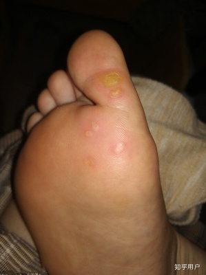 脸上长硬痘痘