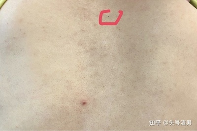 男人背上长痘痘用什么洗