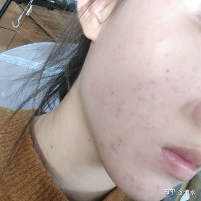 脸颊两侧长小痘痘的原因