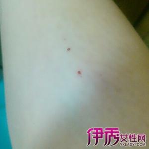 梦见自己长虱子并掐死