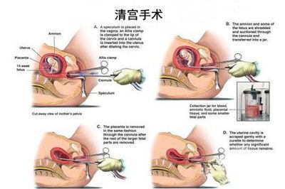 药流和无痛流产费用是多少