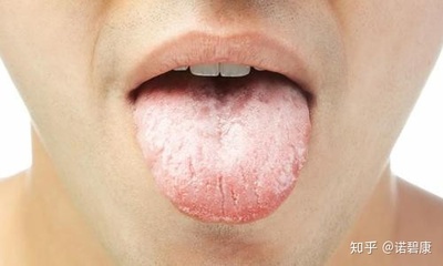 口苦舌苔白是怎么回事