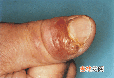 孢子丝菌皮肤病怎么治疗