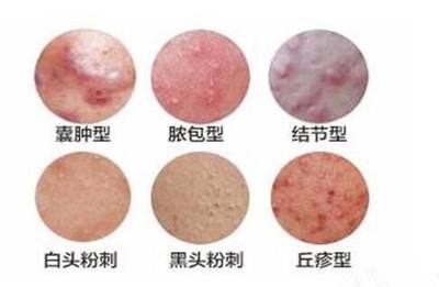 吃辣椒后长的痘痘很痛