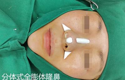 分体式隆鼻