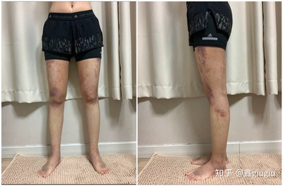 抽脂后疼痛感多久恢复