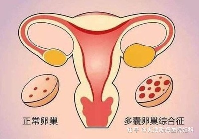 多囊会影响怀孕吗