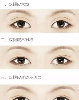 双眼皮不明显咋办