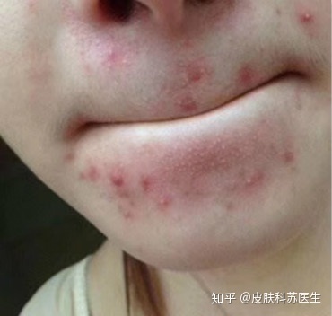 郑州 痘痘