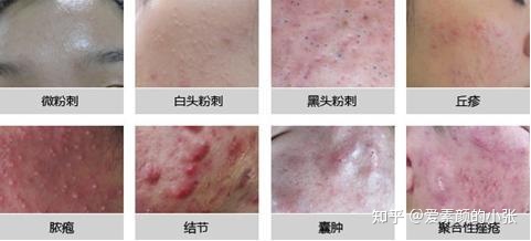 痘痘怎么能治好