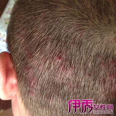 头皮炎怎么治疗
