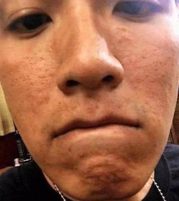 满脸痘痘的照片男