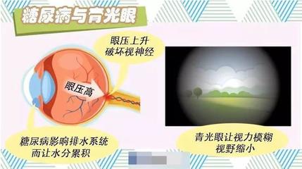 眼睛眼压高是怎么回事