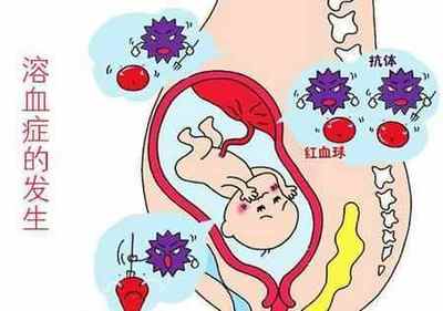 怀孕溶血是什么意思