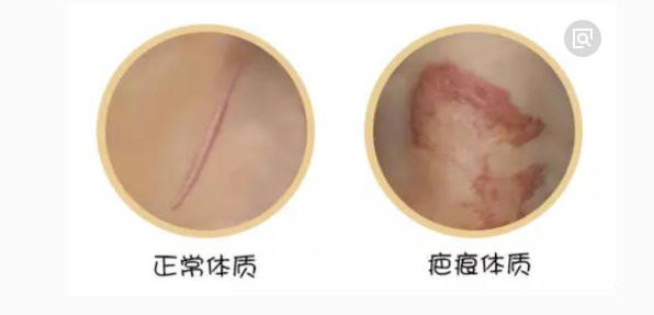 怎么判断自己是疤痕体质