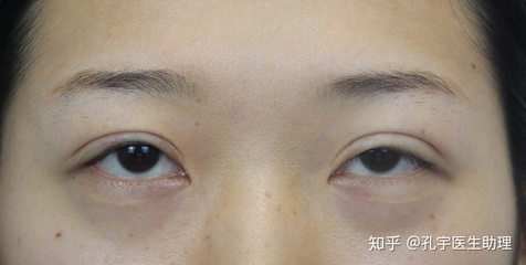 双眼皮割深了