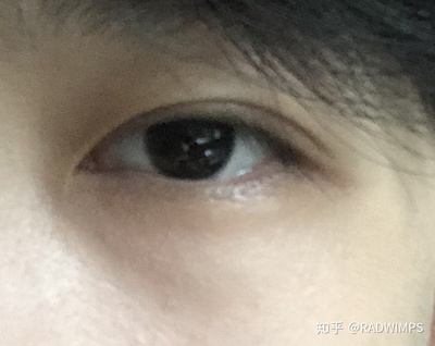 揉眼睛变双眼皮