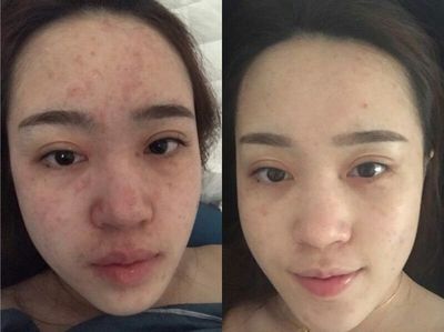 满脸痘痘用什么牌子
