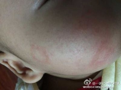 宝宝湿疹可以洗脸吗