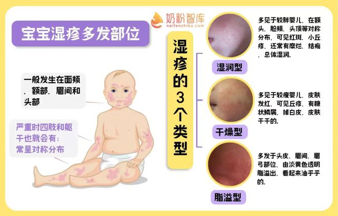 湿疹能喝奶粉吗