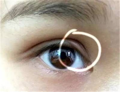 双眼皮上面又条折痕