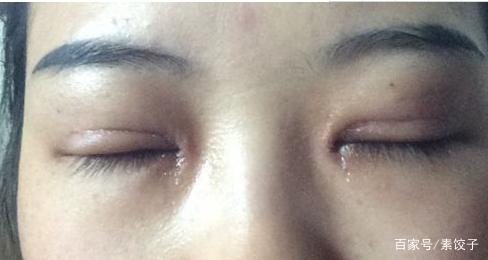怎样才能有双眼皮