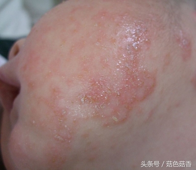 初生婴儿湿疹怎么治疗