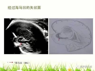 胎儿颅脑超声