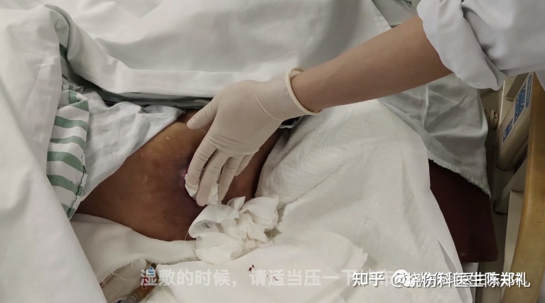 生了褥疮怎么治疗