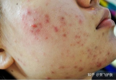 敏感肌肤痘痘发红