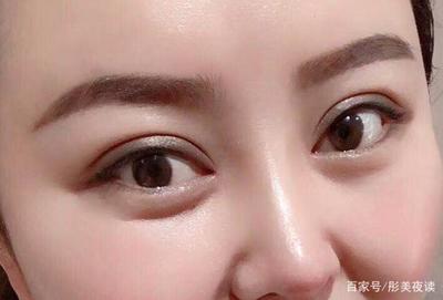 双眼皮有哪几种形状
