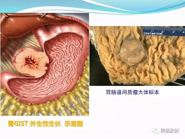 间质瘤是怎么回事