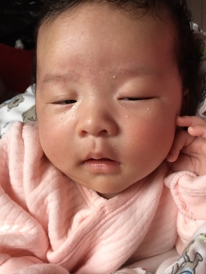 新生儿脸上有脂肪粒